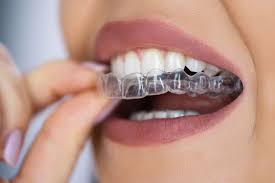 Teeth Aligners Treatment Services