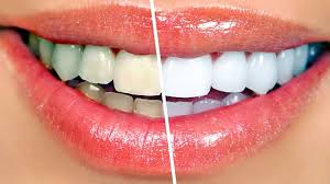 Tooth Whitening Services