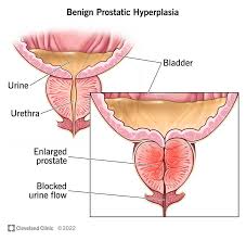 Prostate Problems- BPH. Prostate Cancer Treatment Services