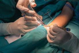 AV Fistula Creation for Dialysis/ CKD Patients