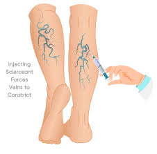 Varicose Veins Treatment