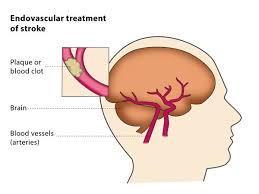 Endovascular Treatment Services