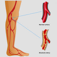 Peripheral Artery Disease Treatment Services